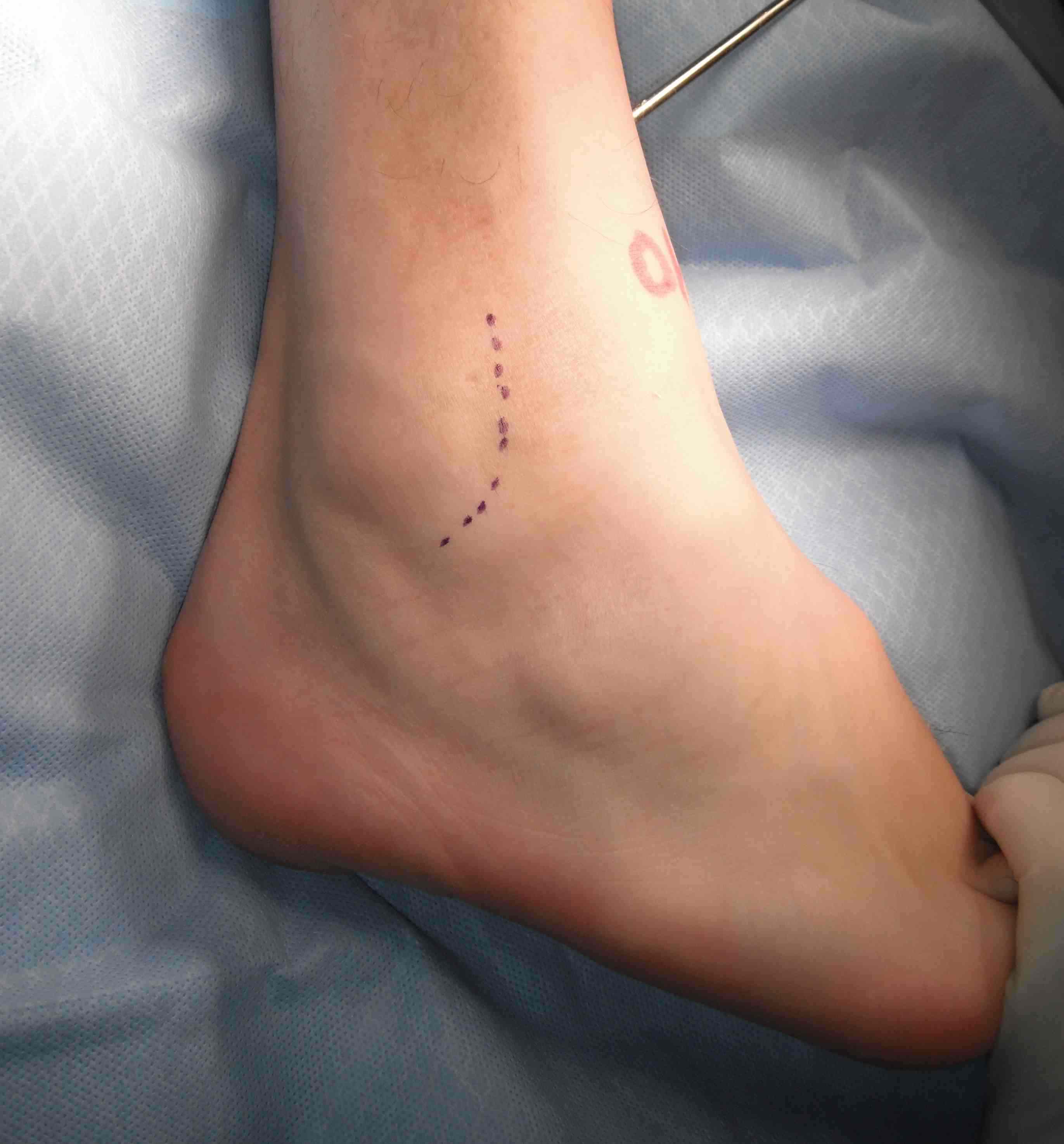 Lateral Ligament Repair Incision